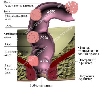 Tumor of the rectum. MCSC patient history