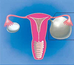 Киста яичника фотография
