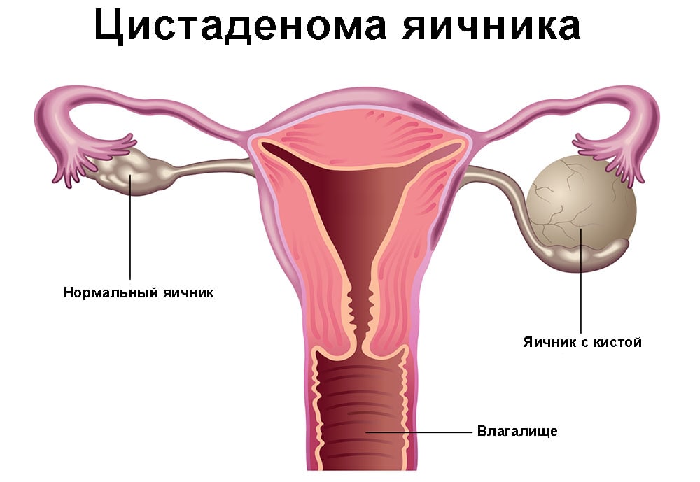 Лапароскопия муцинозной кисты яичника