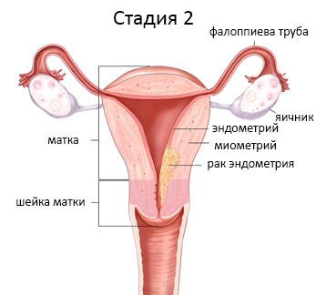 Рак матки - диагностика, лечение ранних стадий рака матки в Москве, Клинический Госпиталь на Яузе
