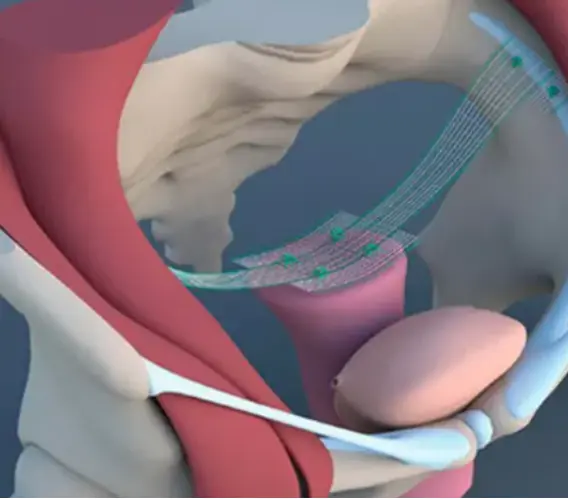 Сетчатый имплент