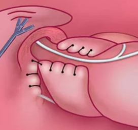 Окончательный вид операционного поля после крурорафии и физиологической фундопликации по Тоупе (270 град)