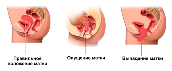 Кольпит при беременности, цены на лечение в Москве «Гемостаз»