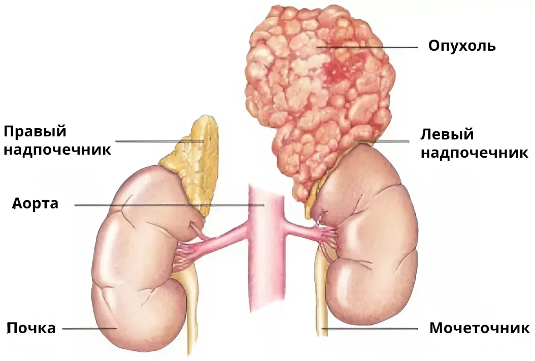 Адренокортикальный рак (АКР)