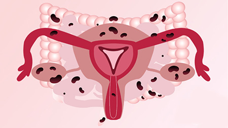 Отзывы пациентов прооперированных с эндометриозом матки