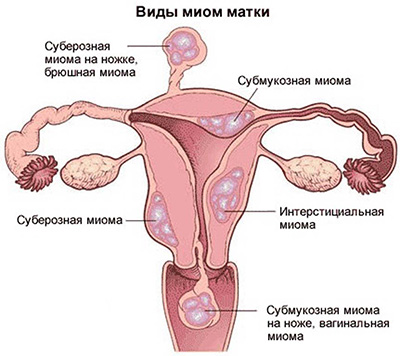 Миома матки - размеры в неделях