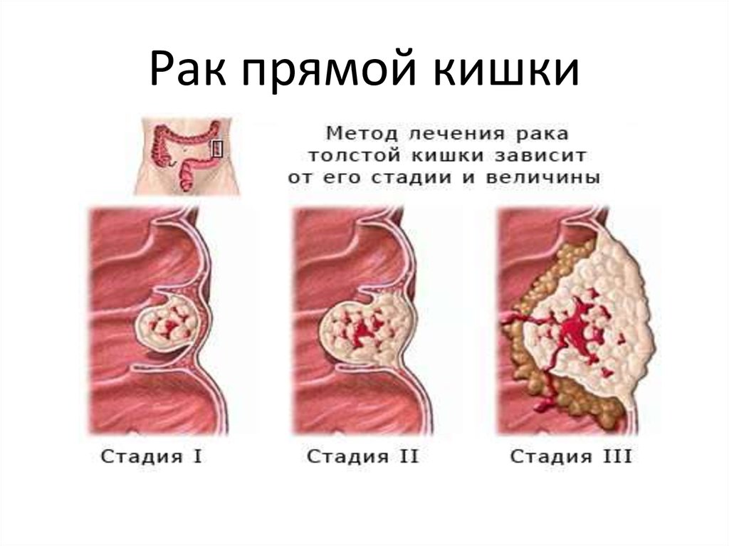 Анальный секс может привести к развитию рака - Новости Калининграда