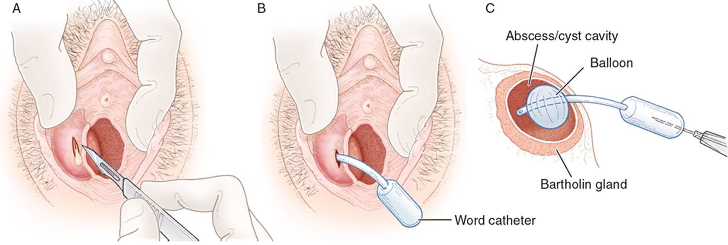 Лазерный способ удаления кисты промежности (вагины, бартолиновой железы)