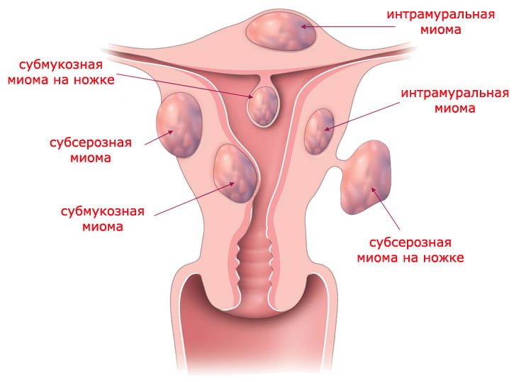 Узловая миома матки что это