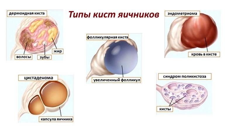 Фолликулярная киста яичника: лечение