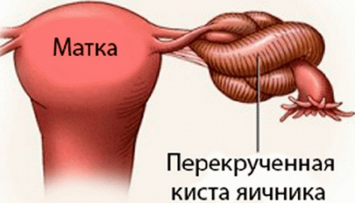 Киста яичника геморрагическая - причины, симптомы, диагностика, лечение и профилактика