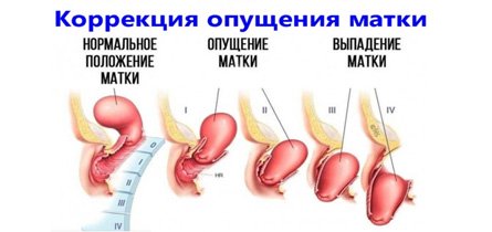 Опущение органов малого таза у женщин♀ Диагностика и лечение в клинике в Москве