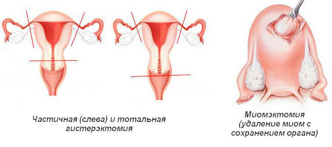 Лечение миомы матки – методы, препараты, средства | Клиника «Линия жизни» в Москве