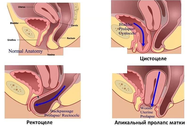 Операции по поводу опущений и выпадений влагалища и матки (пролапс тазовых органов)