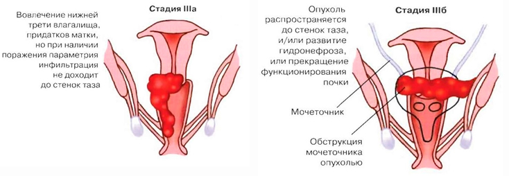 Стадии рака матки