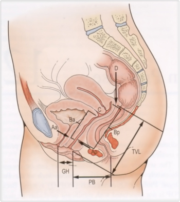 Obstetric aspects of varicose veins of the vulva, vagina and perineum