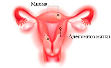 Аденомиоз матки это. Очаговый аденомиоз матки. Миома матки в сочетании с аденомиозом.