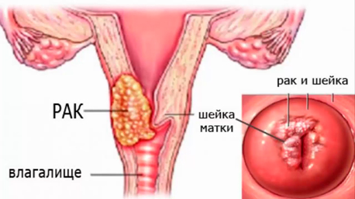 Заболевания шейки матки