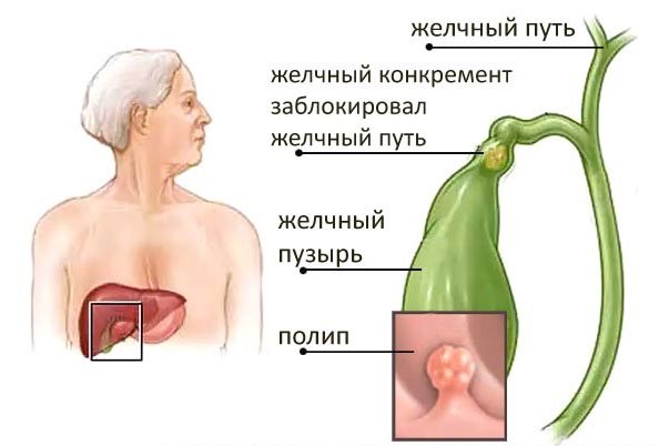 Полипы желчного пузыря. Тактика ведения