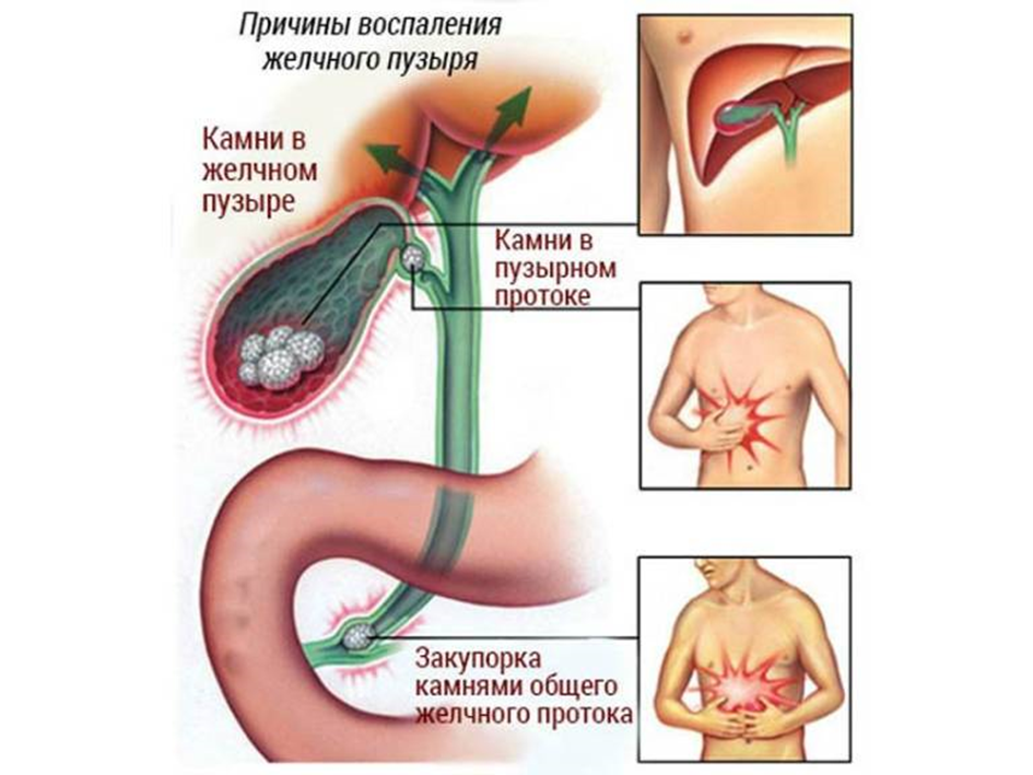 Желчекаменная болезнь: признаки, симптомы, лечение - МедКом