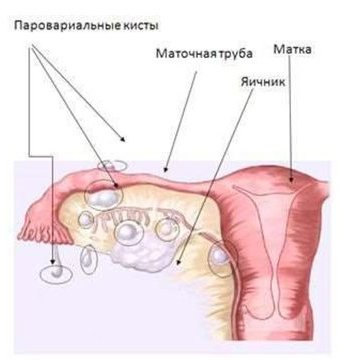 Параовариальная киста: симптомы и лечение