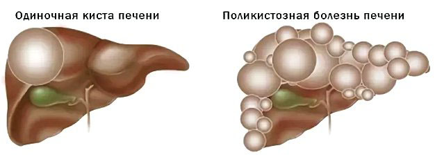 Кисты печени