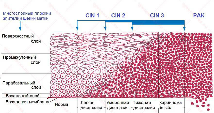 Дисплазия шейки матки - причины симптомы, диагностика и лечение | Практик - сеть медицинских клиник