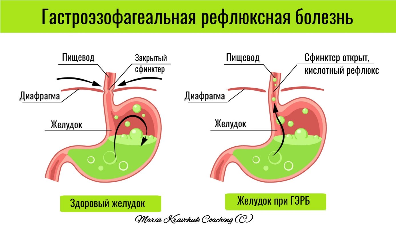 Лечение отрыжкки в Воронеже, симптомы и признаки отрыжкки , диагностика, цены на лечение отрыжкки