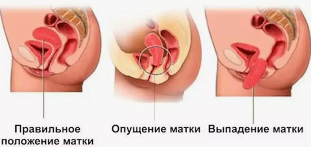 Последствия удаления матки. Выпадение и опущение влагалища: причины, симптомы, лечение, операция.