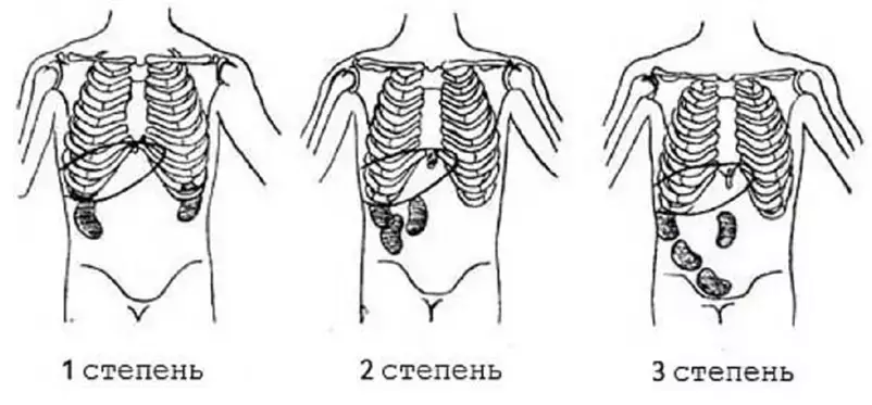 Нефроптоз: степени, симптомы, лечение