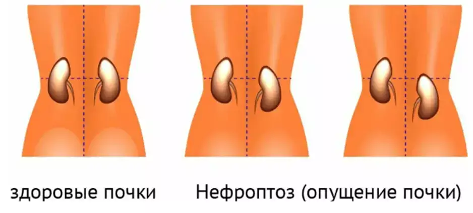 Нефроптоз – причины, симптомы, диагностика, профилактика и лечение | Врачи Онлайн